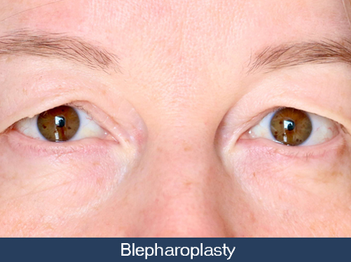 Blepharoplasty in Brantford Ontario