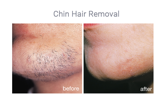 IPL hair removal for chin