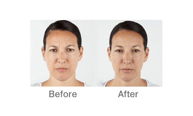 Botox injections in Brantford, Ontario