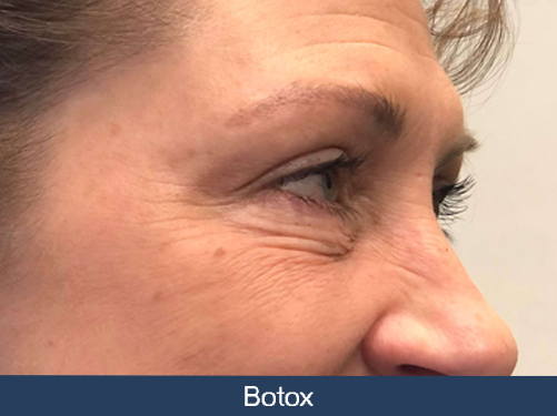Botox Injections in Brantford Ontario