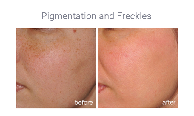Photorejuvenation treatment for pigmentation and freckles