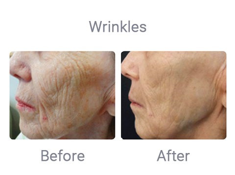 Microneedling treatment for wrinkles