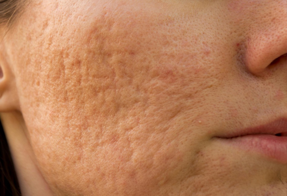 Treatments for Acne Scars in Brantford Ontario