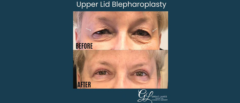 Brighten Your Eyes and Life with Upper Lid Blepharoplasty