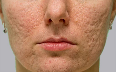 Acne Scar Treatment in Brantford Ontario