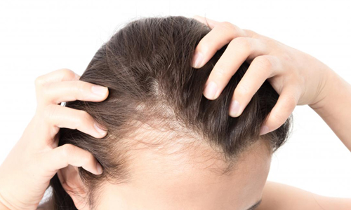 Hair Loss Treatment in Brantford Ontario