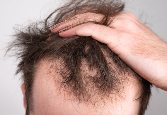 Treatments for Hair Loss in Brantford Ontario