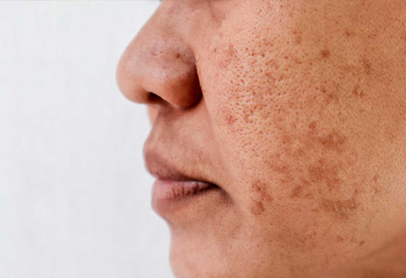 Treatments for Sun Damaged Skin in Brantford Ontario